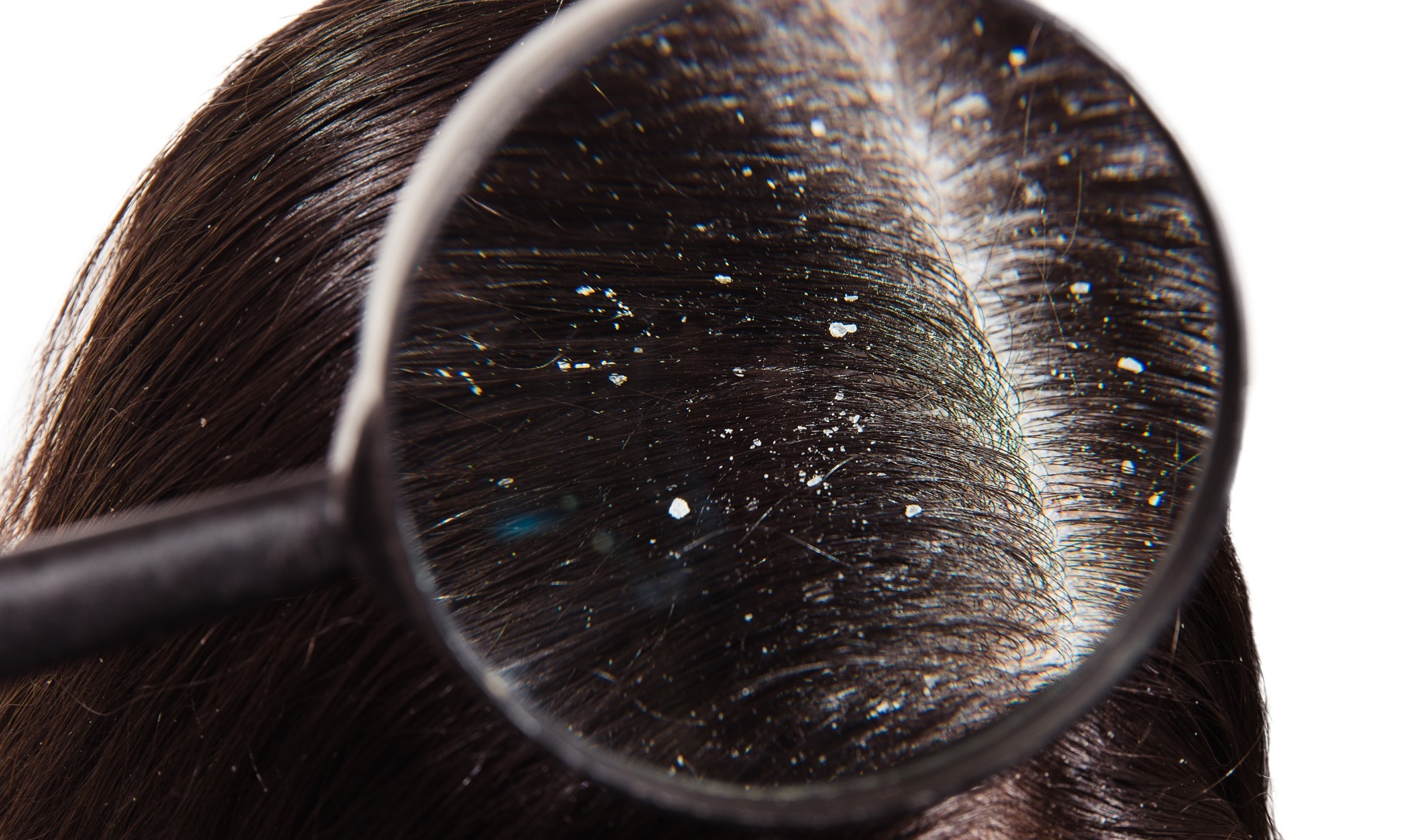 Mirip Ketombe, Psoriasis Gangguan Kulit Kepala Yang Sering Diremehkan