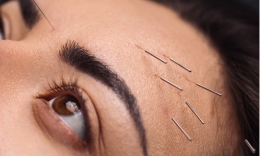 Menenangkan Migrain Lewat Akupunktur