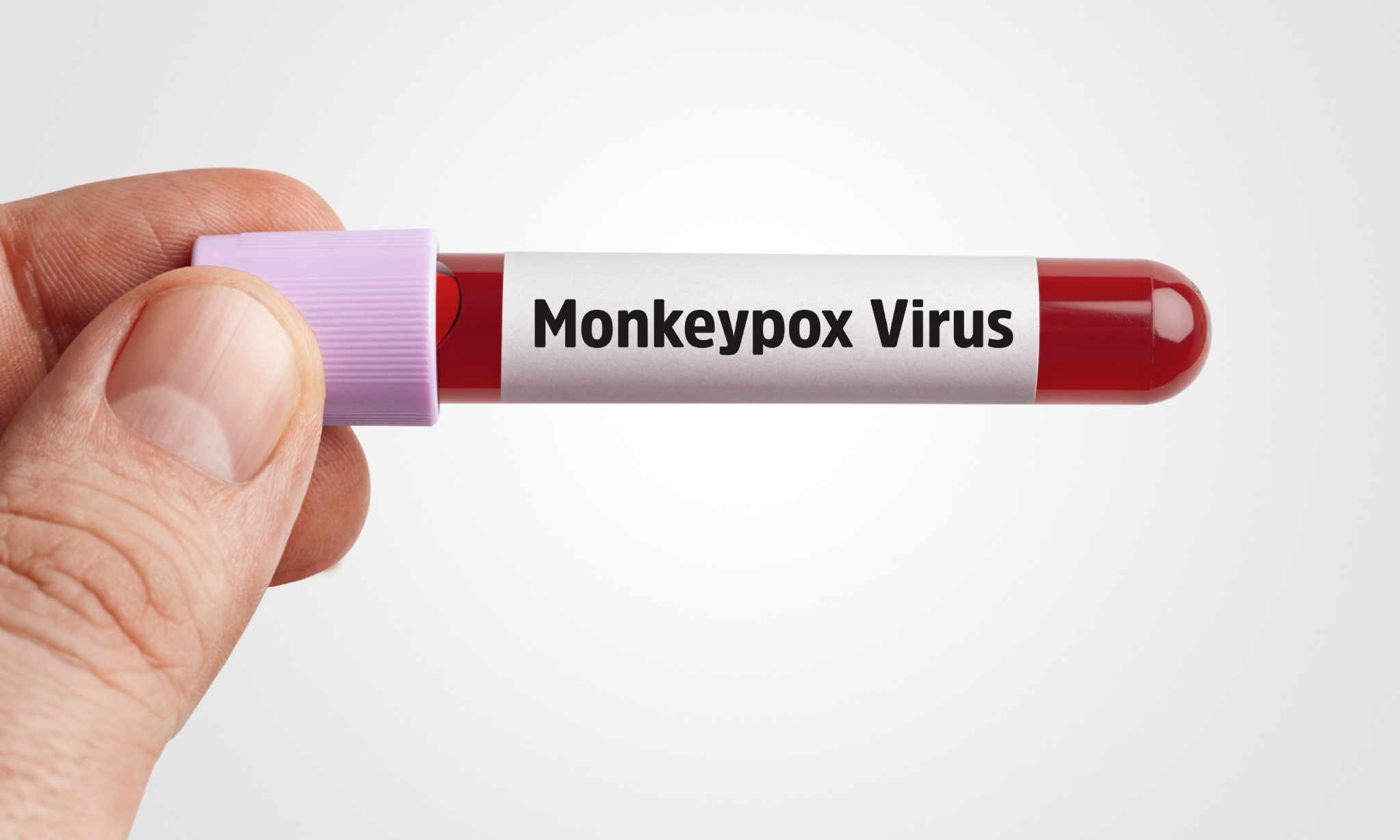 Pasien Monkeypox Di Indonesia Sembuh