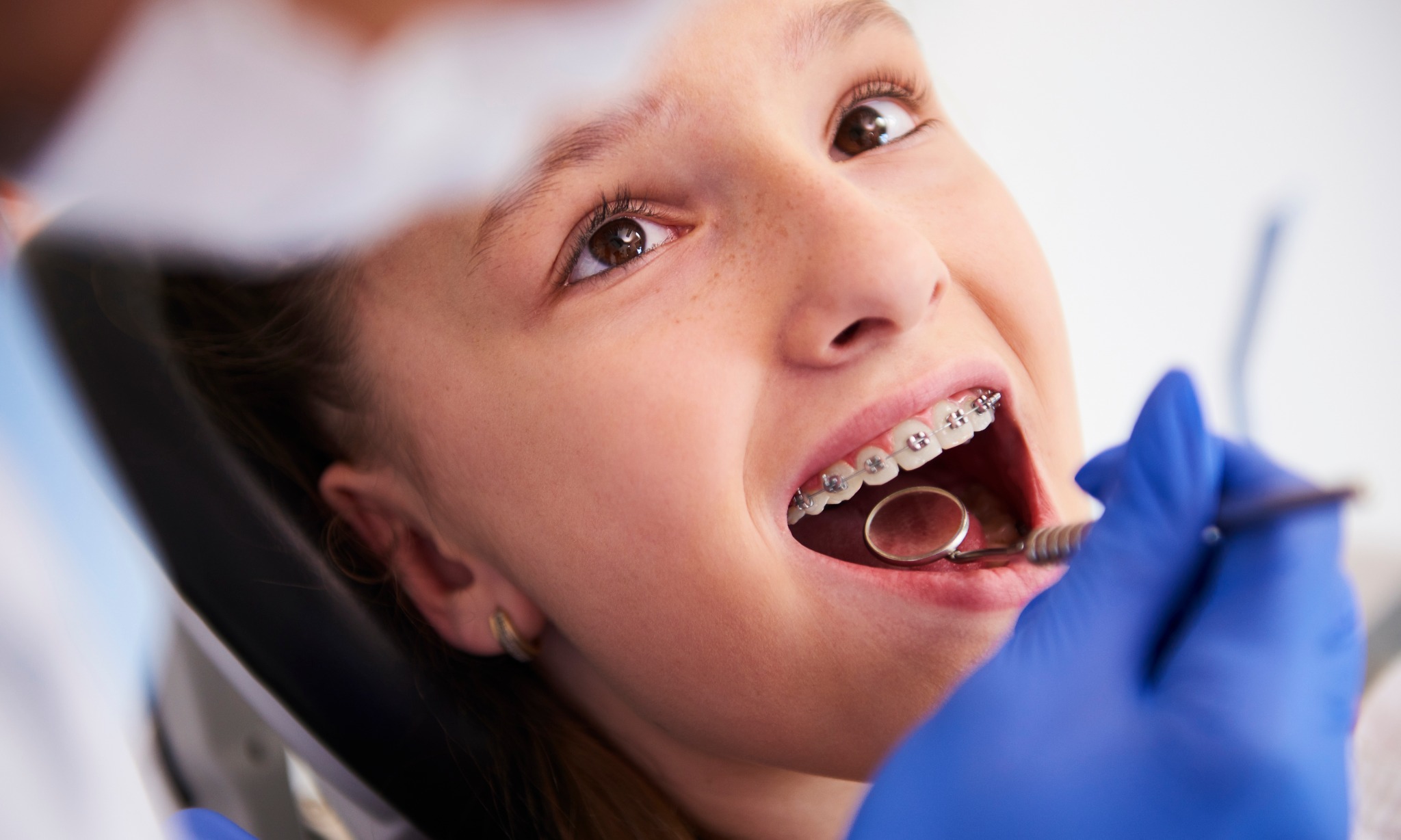 Installation of braces in children can make the structure worse World Today News