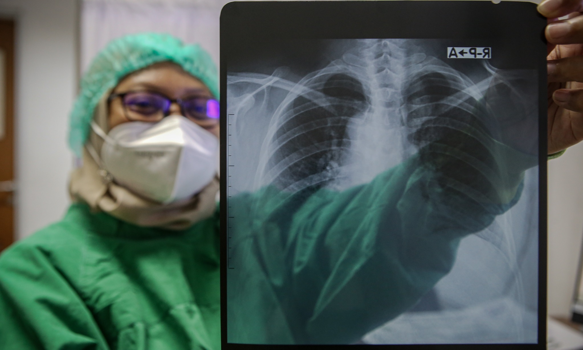 Diagnosis Minim Hambat Pemberantasan Tuberkolosis