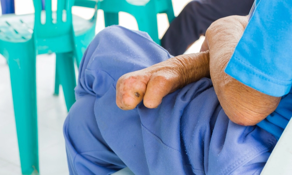 <p>Indonesia Negara Ketiga Terbanyak Jumlah Penderita Kusta</p>