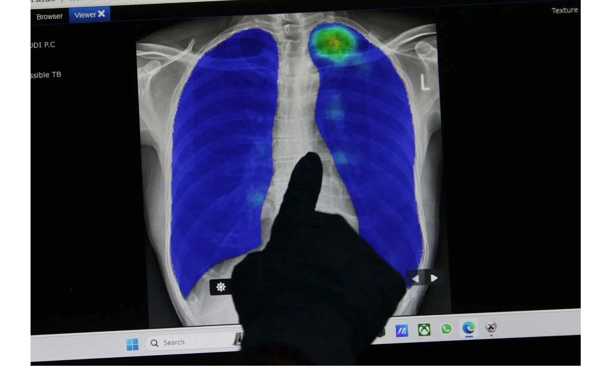 <p>Indonesia Sumbang 10% TBC Dunia</p>