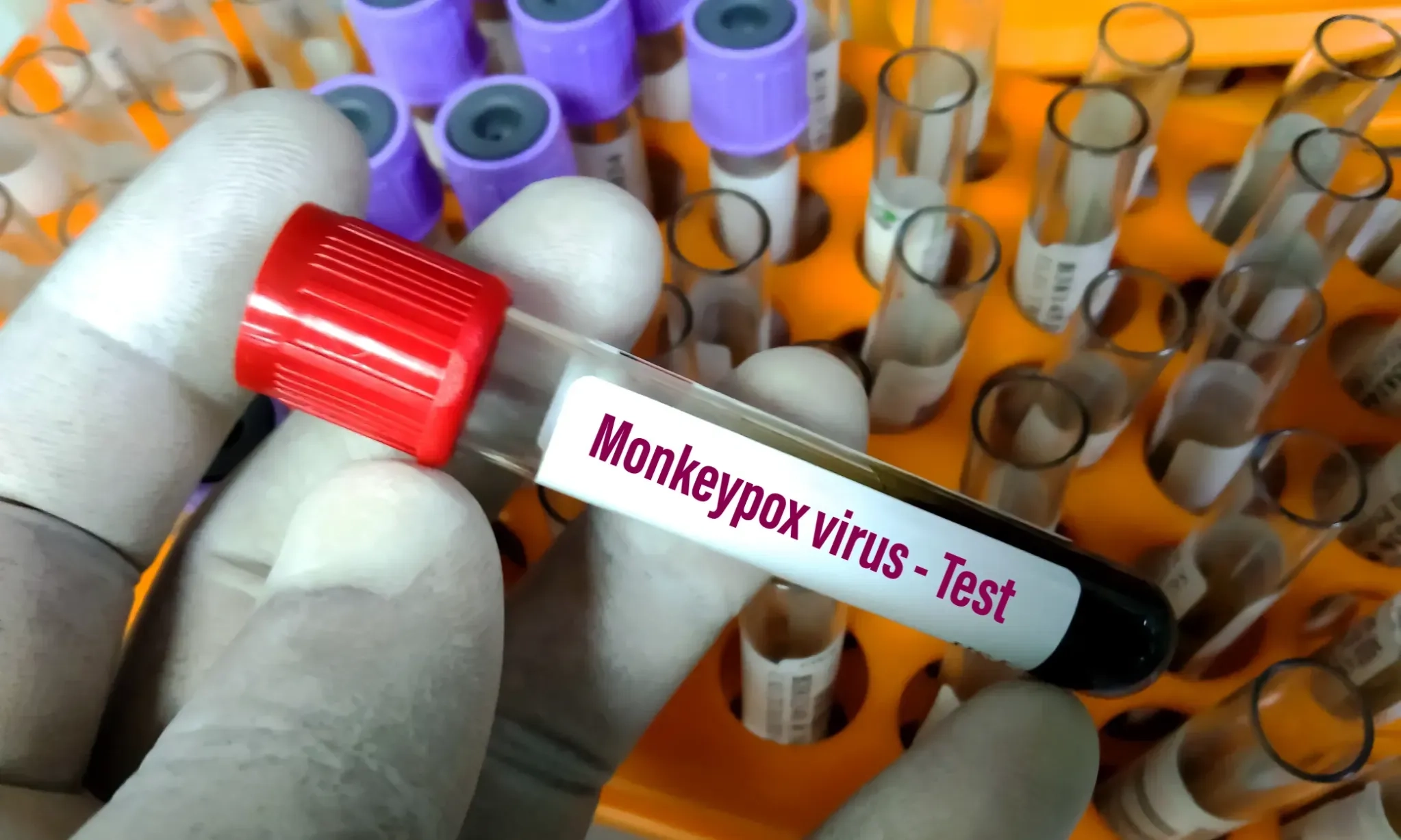 <p>Mengenal Mpox Yang Tengah Jadi Kegawatdaruratan Dari WHO </p>