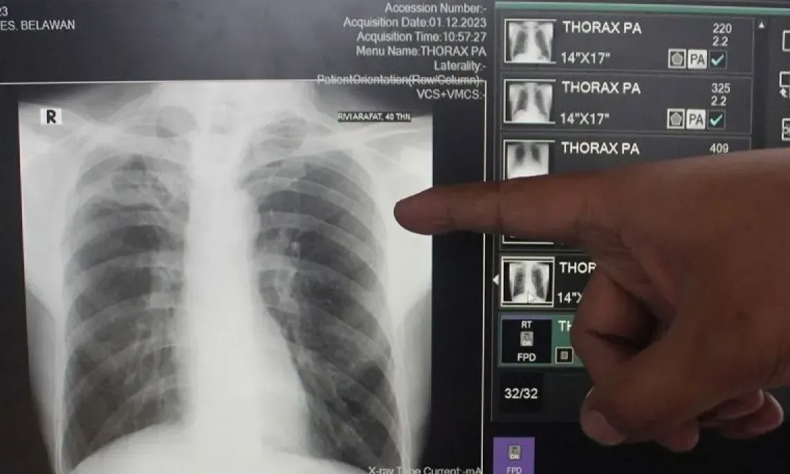 <p>Maret 2025, Kemenkes Deteksi 889 Ribu Orang Mengidap TB</p>