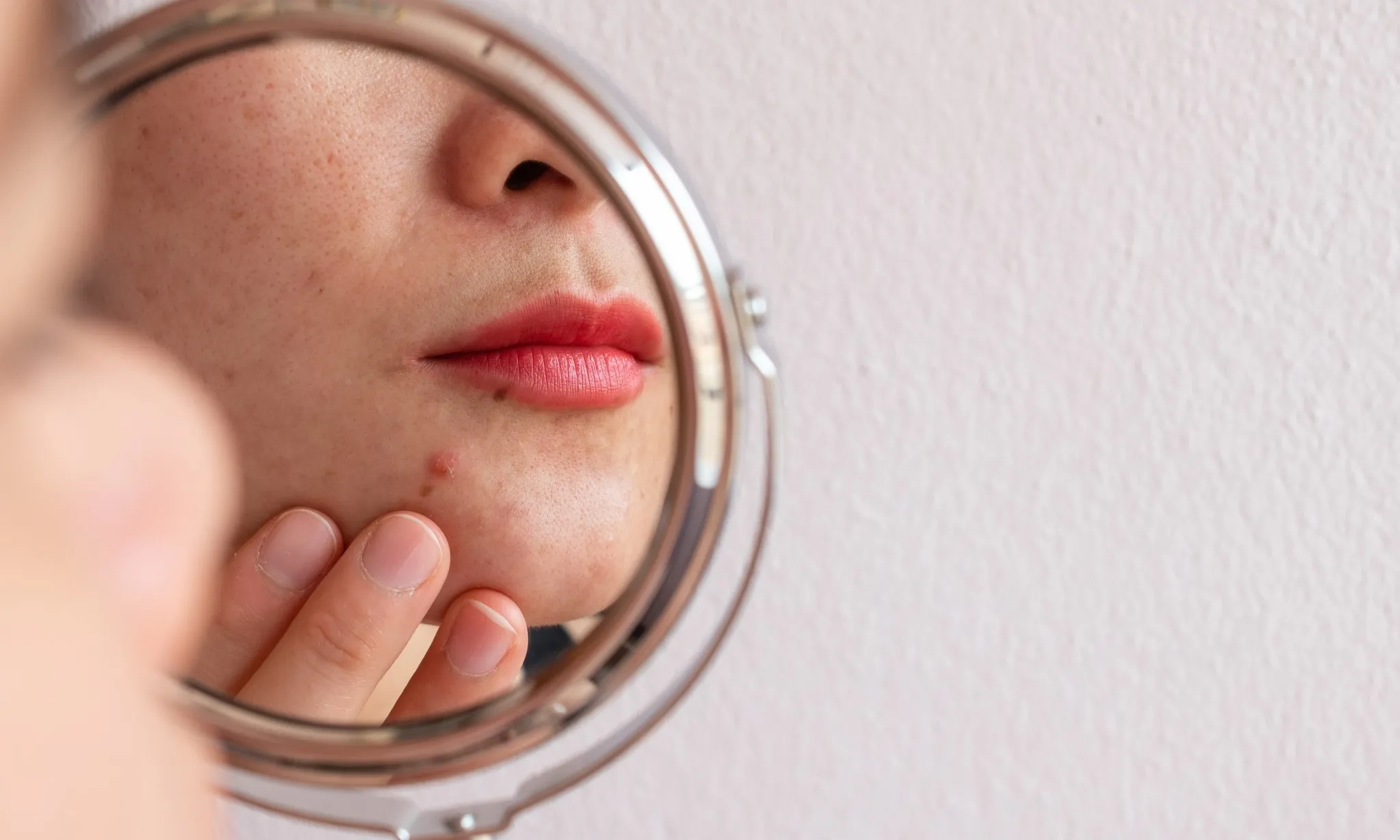 <p id="isPasted">Jerawat Membandel? Ini Solusi Dan Perawatan Yang Disarankan Dokter</p>