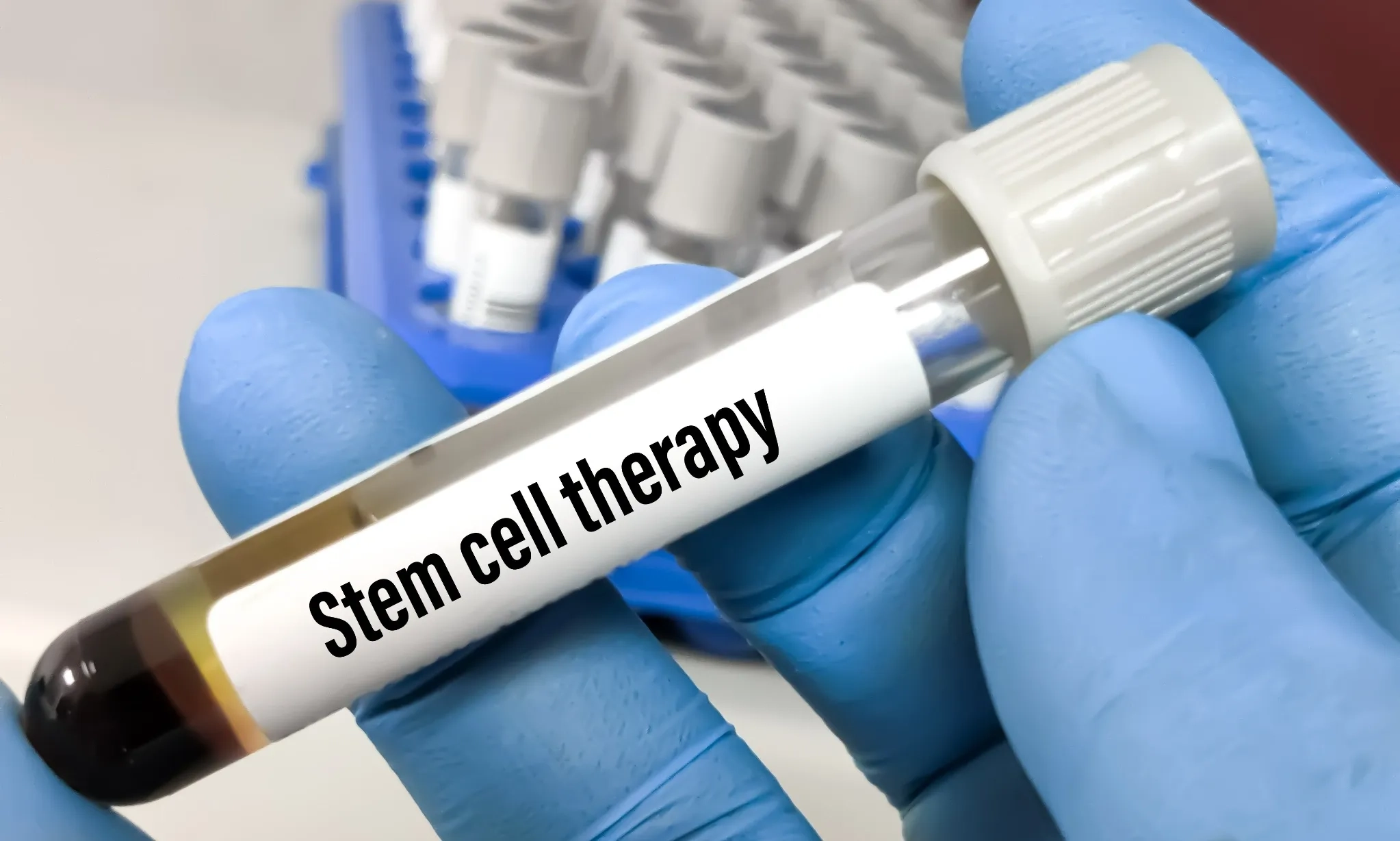 <p><em>Stem Cell</em> Ortopedi Di Indonesia Lebih Unggul Dari Negara Tetangga</p>