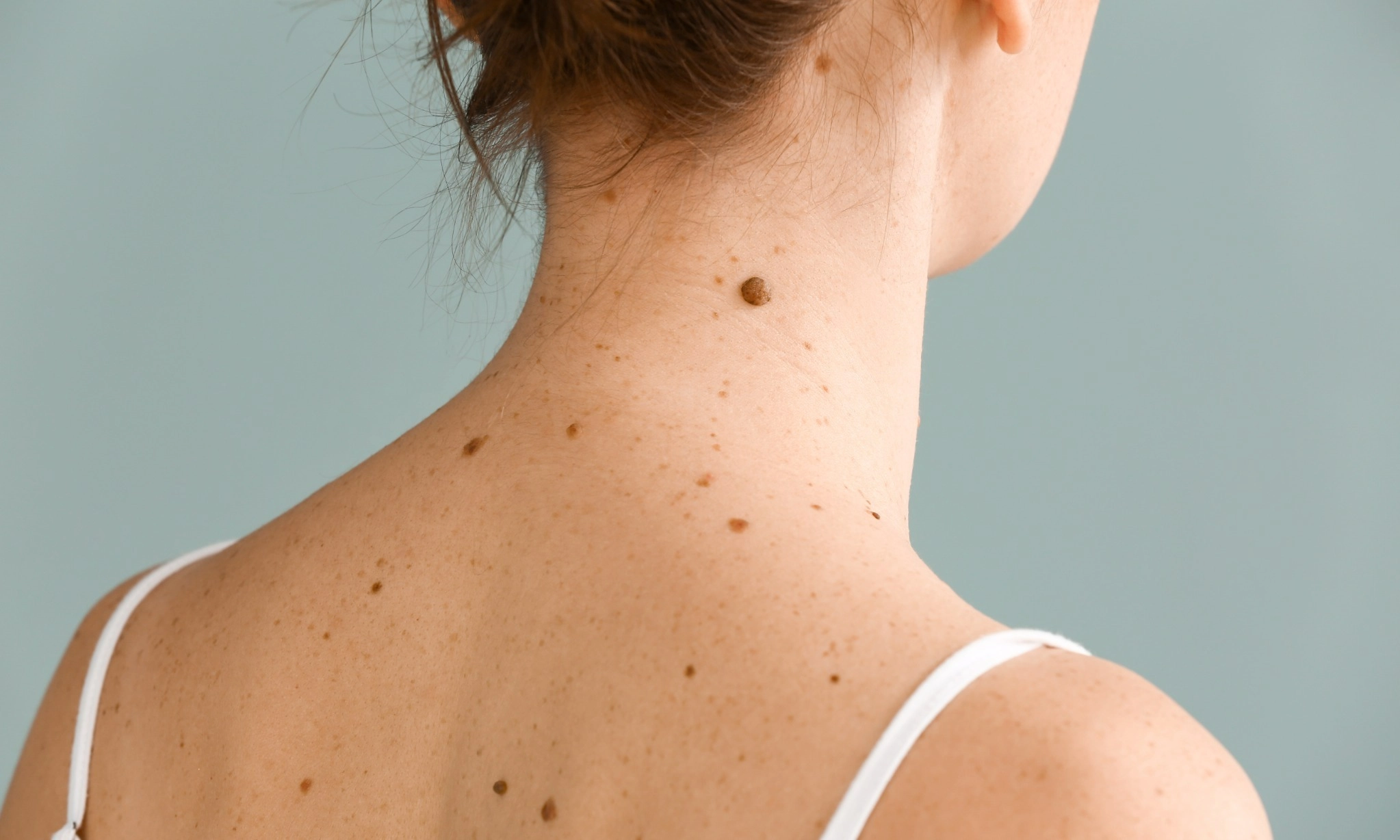 <p>Kenali Ciri Tahi Lalat Cikal Bakal Kanker Kulit</p>