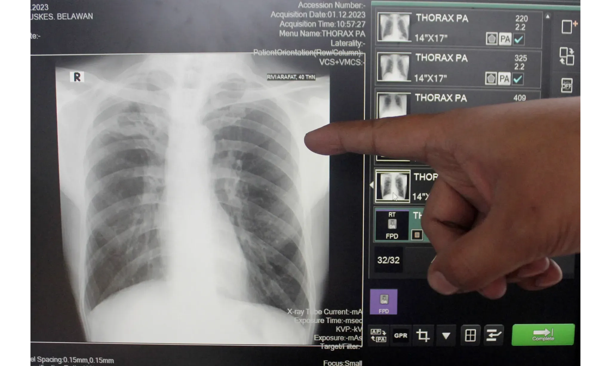<p>Dokter Sebut Belum Ada Terapi Pengobatan Baru TB</p>