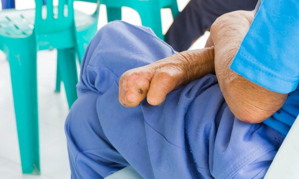 <p>Indonesia Peringkat Ketiga Kasus Kusta Terbanyak Di Dunia</p>