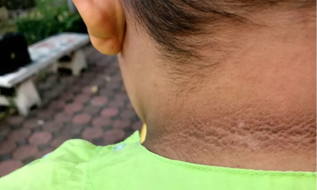 <p>Leher Hitam Pada Anak Penanda Diabetes</p>