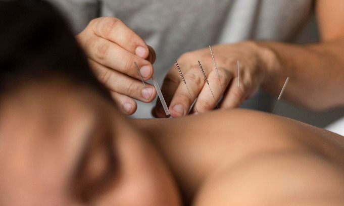 Akupuntur Bisa Kurangi Efek Samping Kemoterapi
