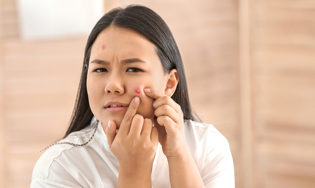 Berhenti Konsumsi Gorengan Sebagai Langkah Awal Hindari Jerawat