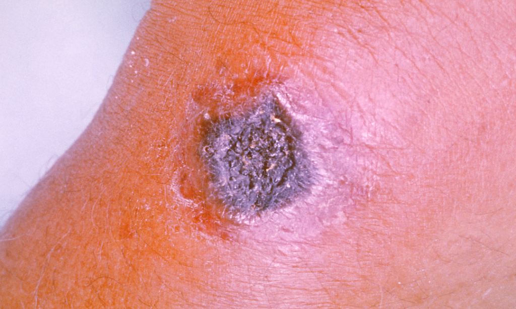 Mengenal Sejarah Dan Sulitnya Menghadapi Antraks