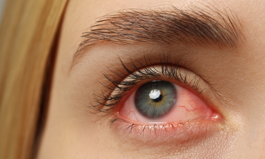 Megenali Gejala Awal Sifilis Mata Okuler