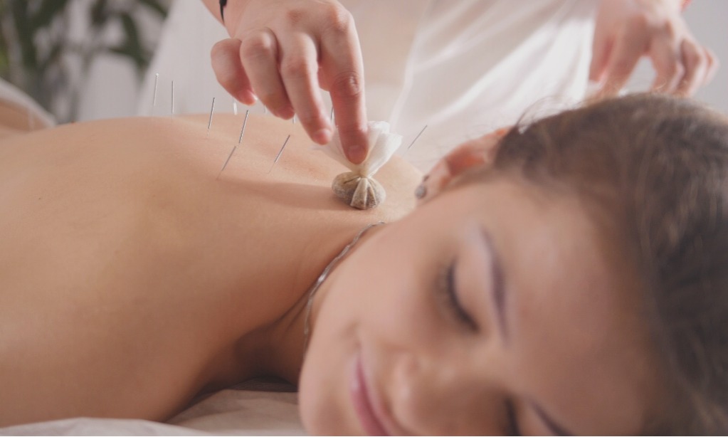 Mengenal Tiga Jenis Akupuntur