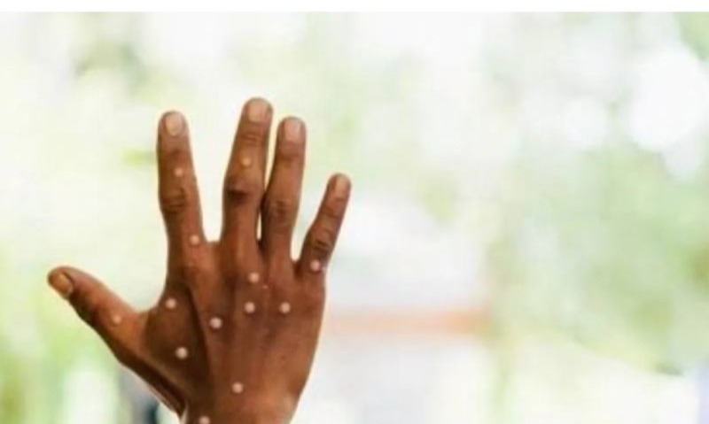 Pakar Sarankan Tetap Waspada Cacar Monyet