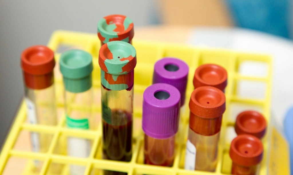 <p>Tes Darah Dengan Bantuan AI Bisa Prediksi Parkinson Tahunan Sebelum Gejala</p>