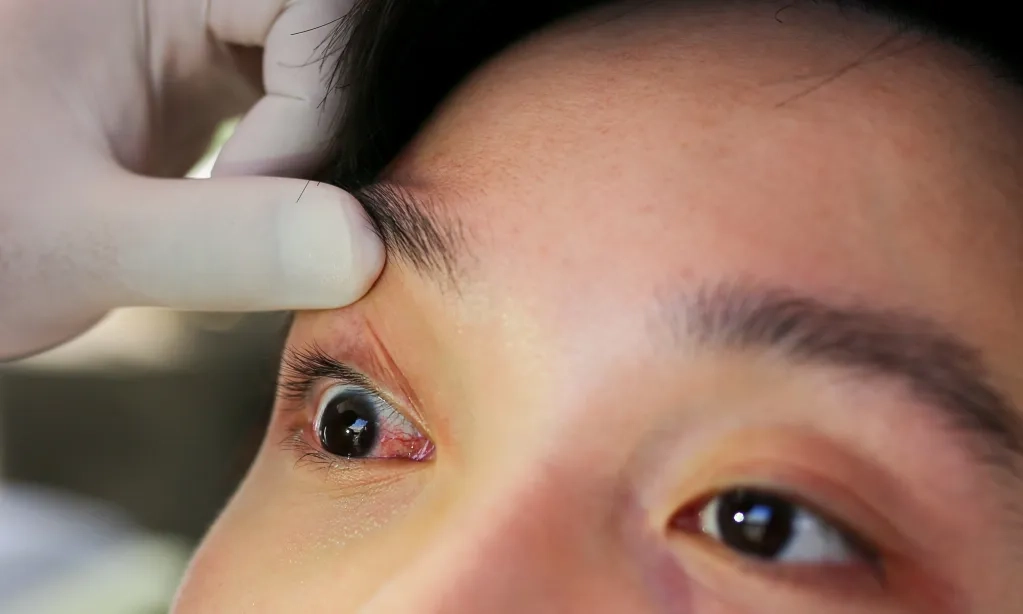 <p>Apa Itu Ablasio Retino, Penyakit Mata Yang Rentan Terjadi Di Usia 40-an</p>