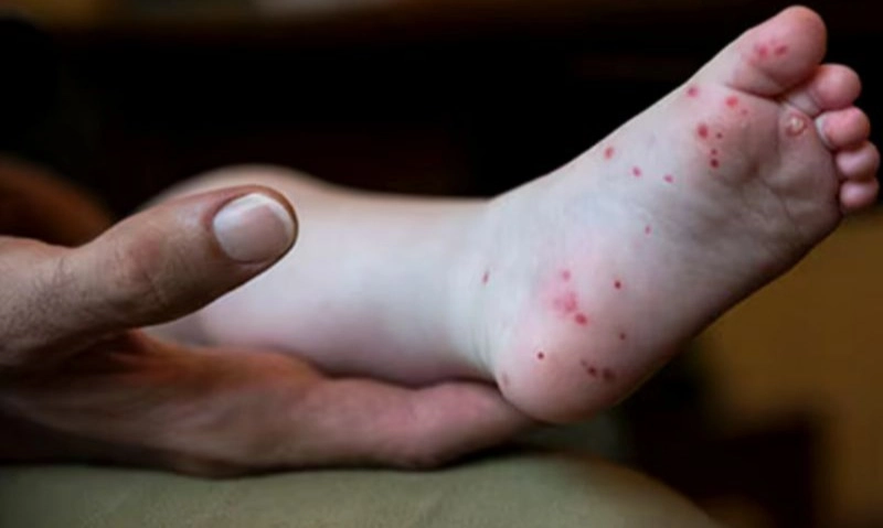 <p>Kiat Merawat Pasien Flu Singapura Di Rumah Tanpa Khawatir Menularkan</p>