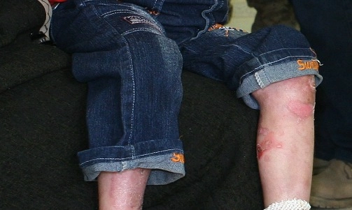 <p><em>Butterfly Disease</em>, Kondisi Yang Membuat Kulit Bercorak Seperti Sayap Kupu-Kupu</p>