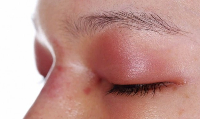 <p id="isPasted">Penyakit Chagas Bisa Berujung Kematian, Ini Cara Pencegahannya</p>