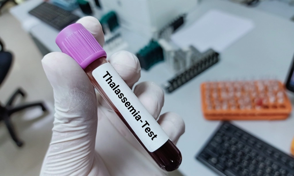 <p>Penderita Talasemia di Indonesia Meningkat</p>