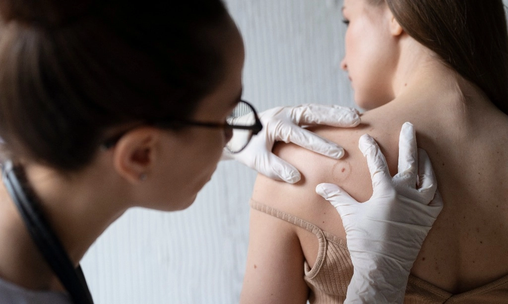 <p>Jangan Sepelekan Gigitan Serangga, Bisa Sebabkan Selulitis</p>