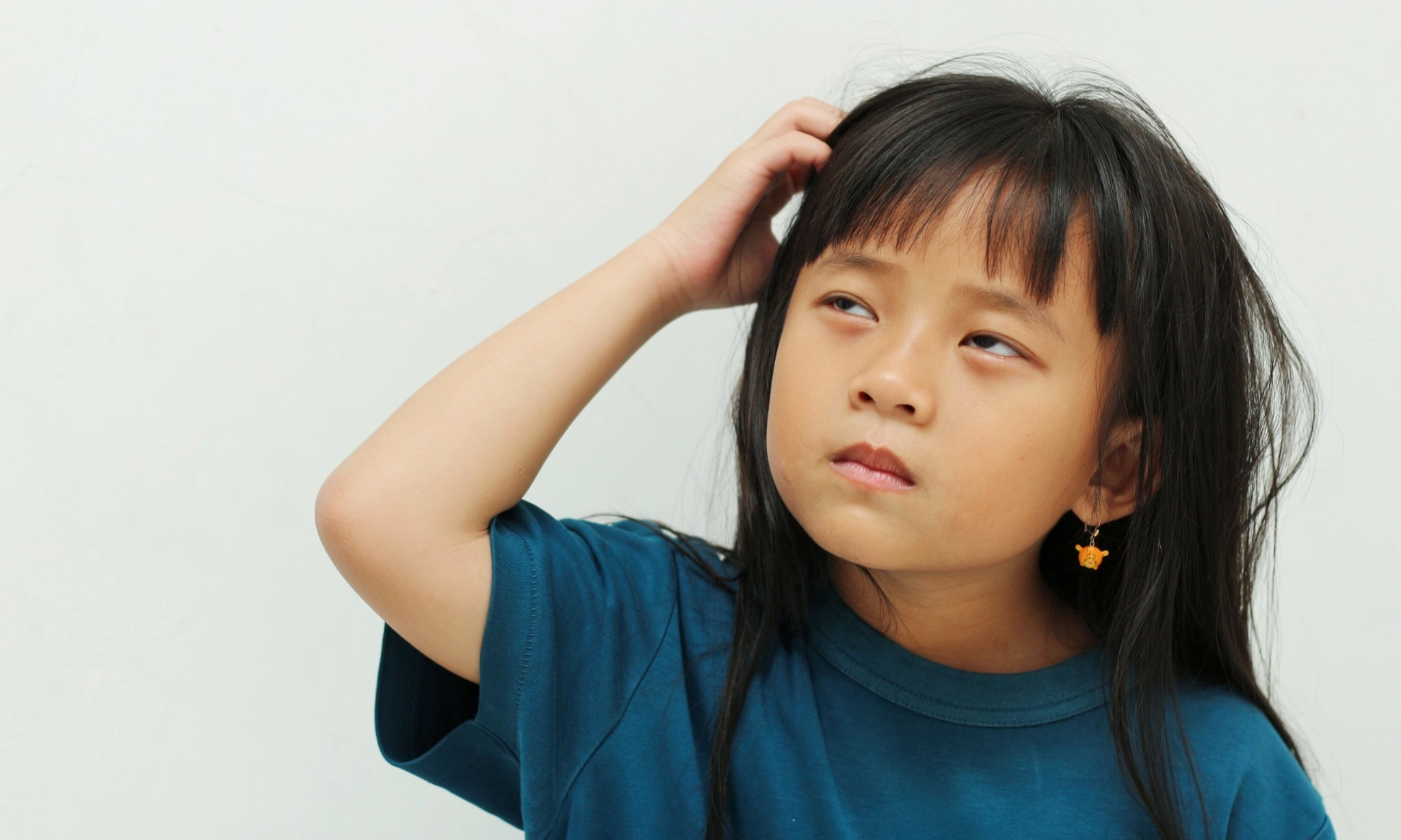 <p>Sindrom M&ouml;bius: Saat Wajah Tak Dapat Mengungkap Perasaan</p>