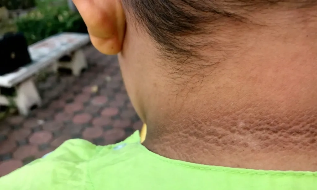 <p>Leher Hitam Pada Anak Penanda Diabetes</p>