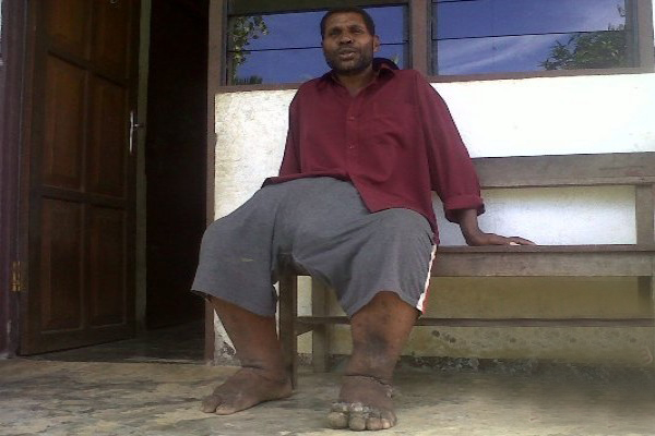 Kemenkes: 236 Kabupaten-Kota Endemis Kaki Gajah