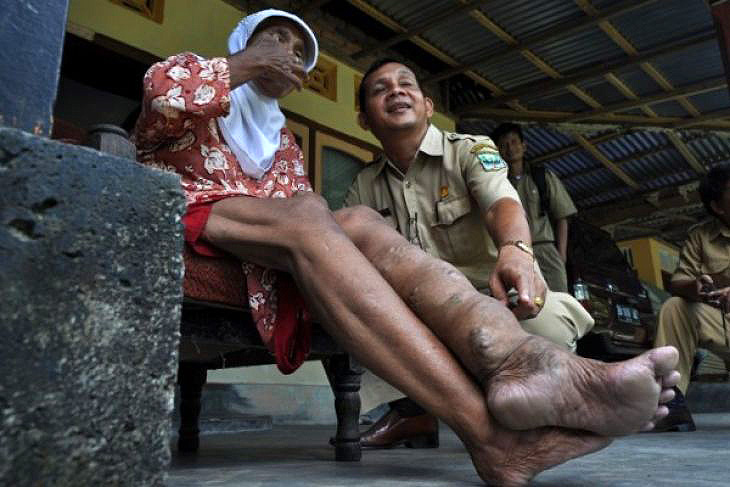 Mimika Kampanyekan Minum Obat Kaki Gajah