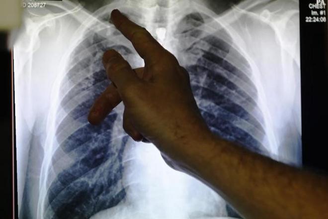 5 Cara Agar Terhindar Dari Tuberkolosis