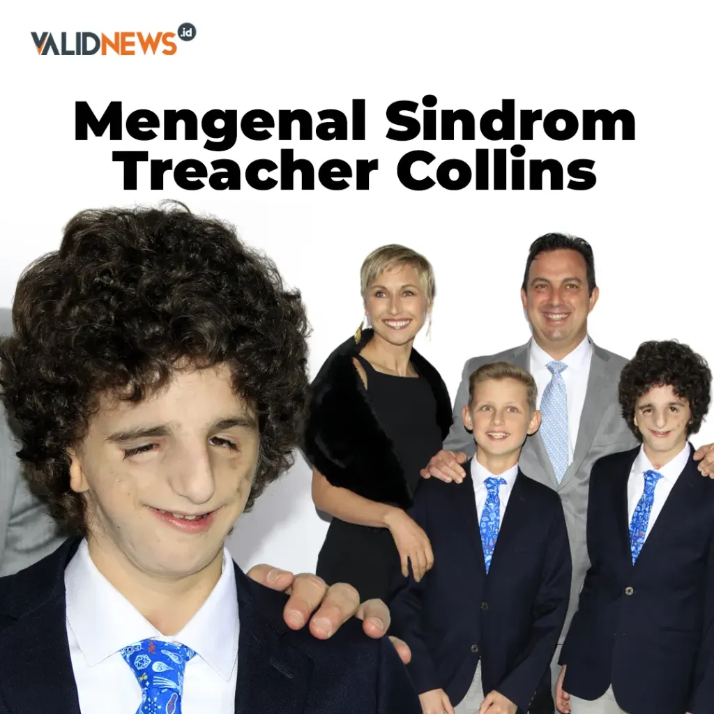 Mengenal Sindrom Treacher Collins