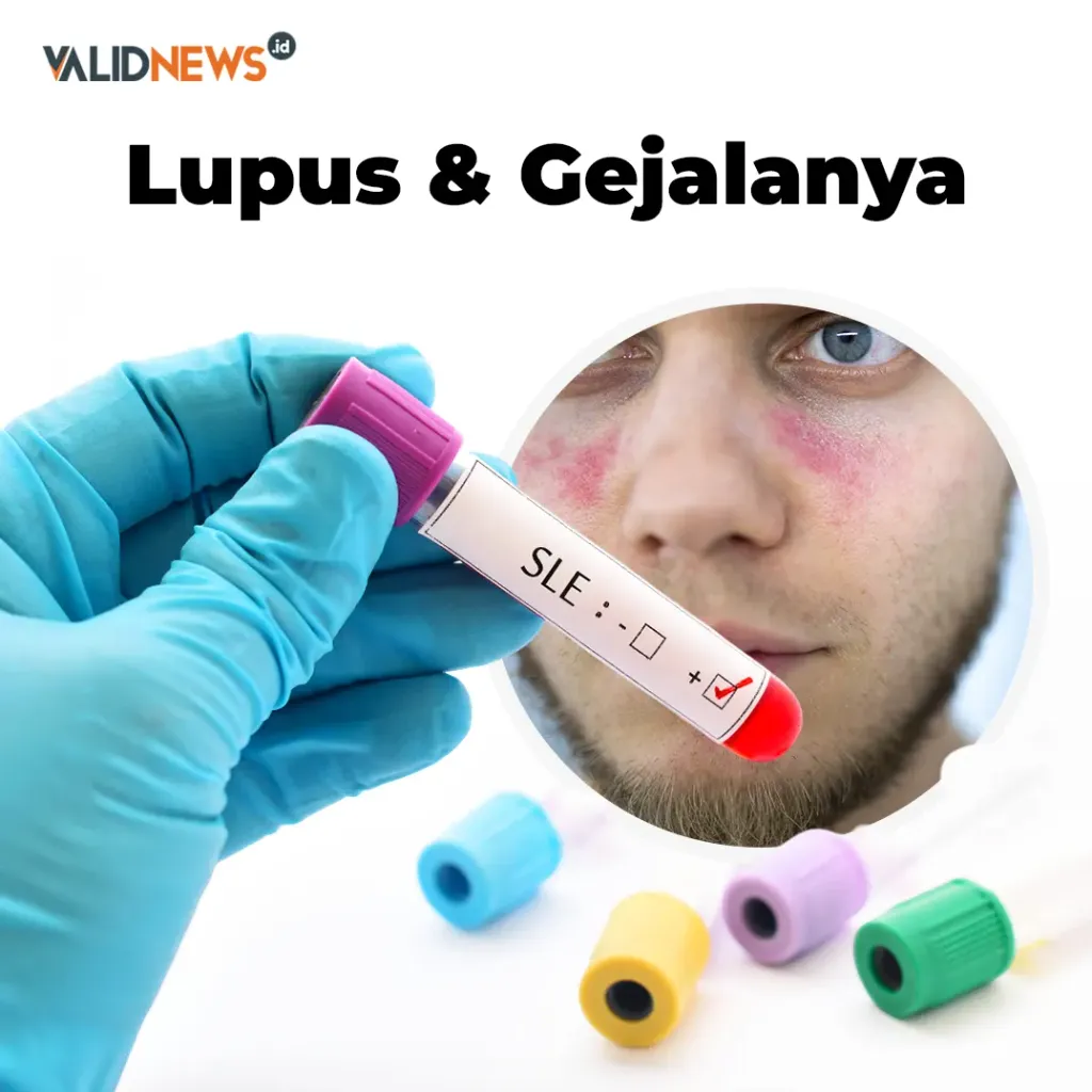 Lupus & Gejalanya